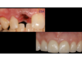 Implant%20Replacement